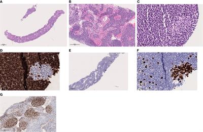 Case Report: Tyrosine Kinase Inhibitors Induced Lymphadenopathy in Desmoid Tumor Patients